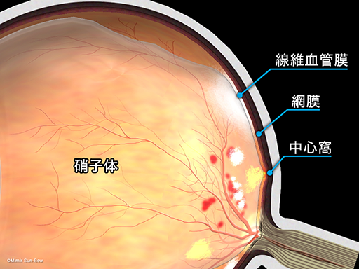 牽引性網膜剥離の症状
